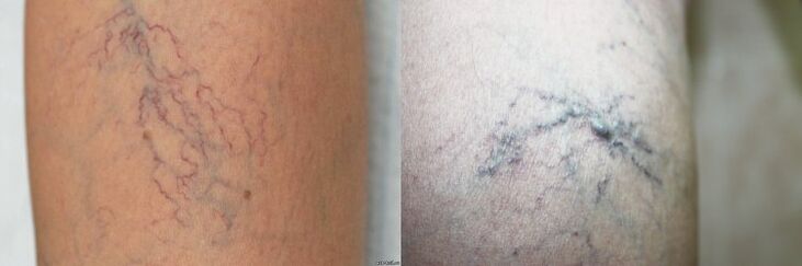 Simptomi varikoznih vena