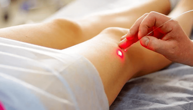 Laserska koagulacija varikoznih vena