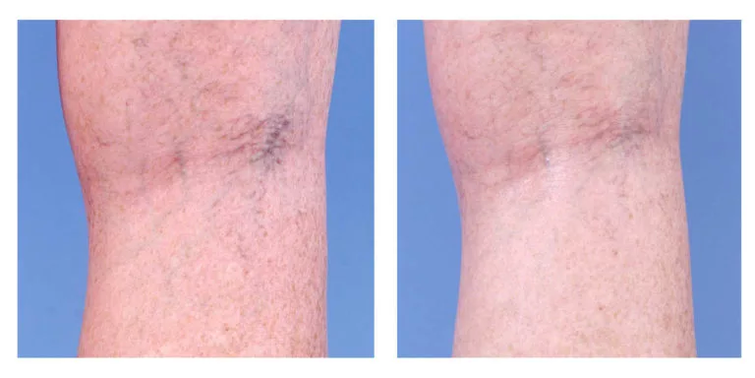 Kozmetička korekcija