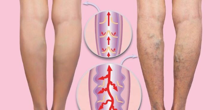 zdrave i proširene vene na nozi
